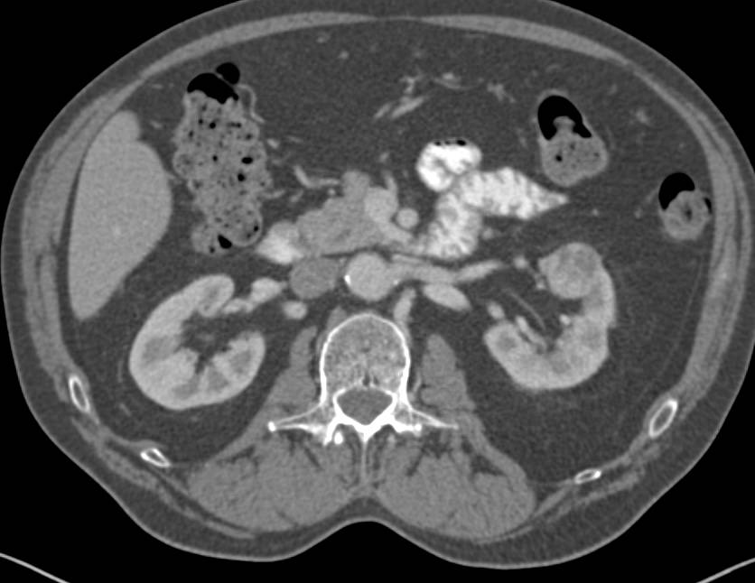 Incidental Left 2 cm Renal Cell Carcinoma - CTisus CT Scan