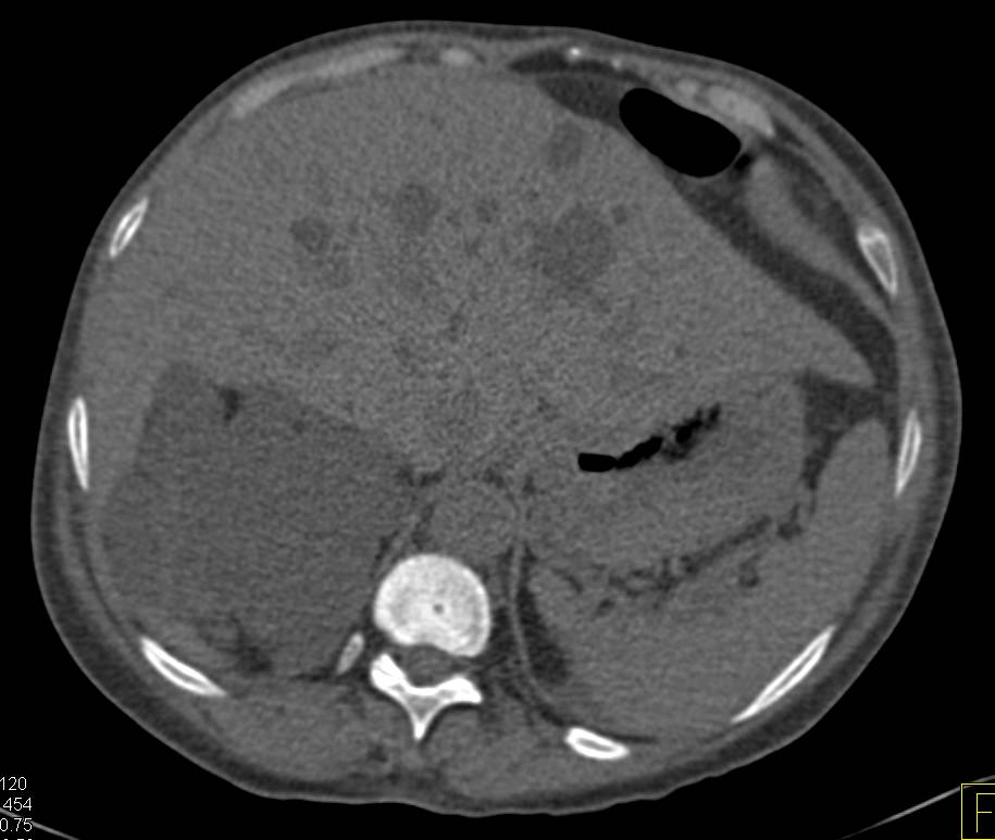 Polycystic Kidney Disease with Hemorrhagic Cysts - CTisus CT Scan