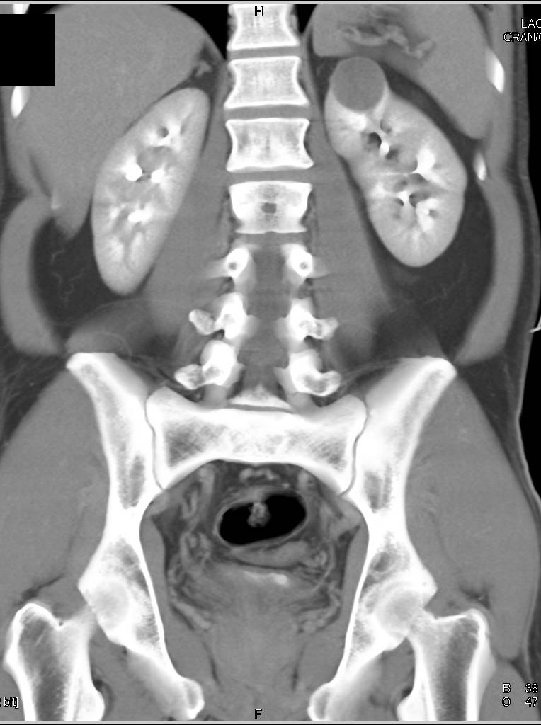 High Density Cyst Upper Pole Left Kidney - CTisus CT Scan