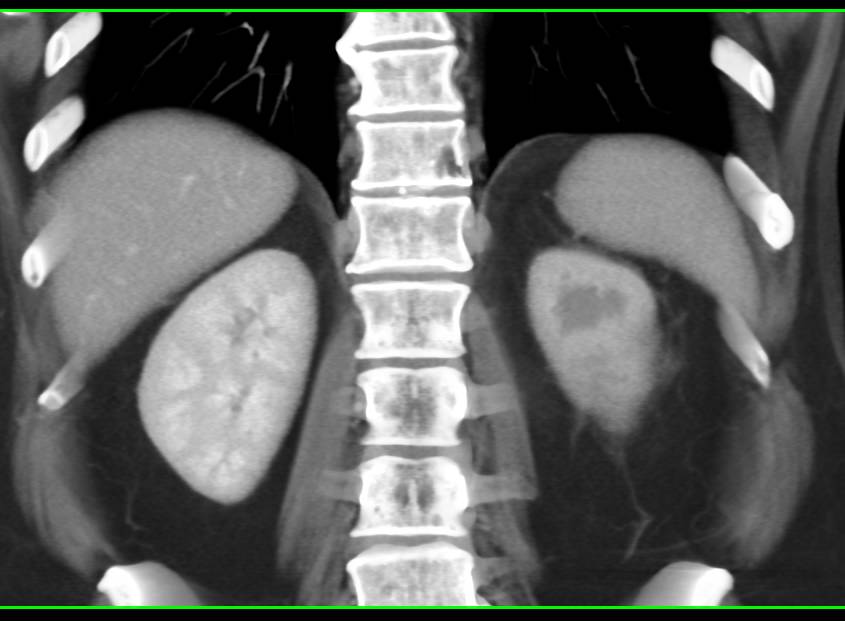 Left Hydronephrosis due to Bladder Cancer - CTisus CT Scan