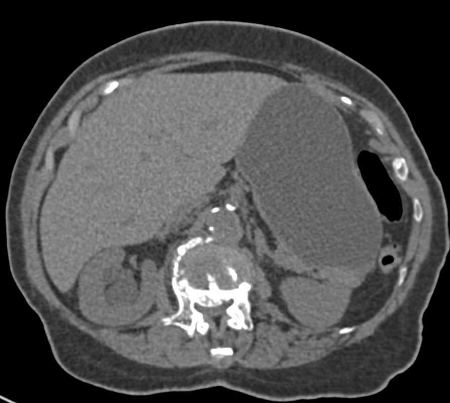 Obstructing Stone in the Right Ureter - CTisus CT Scan