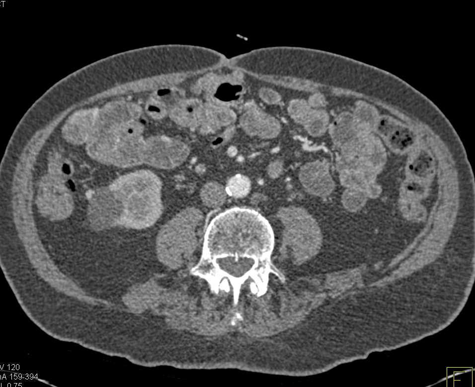 5mm Renal Cell Carcinoma at the Edge of a Renal Cyst - CTisus CT Scan