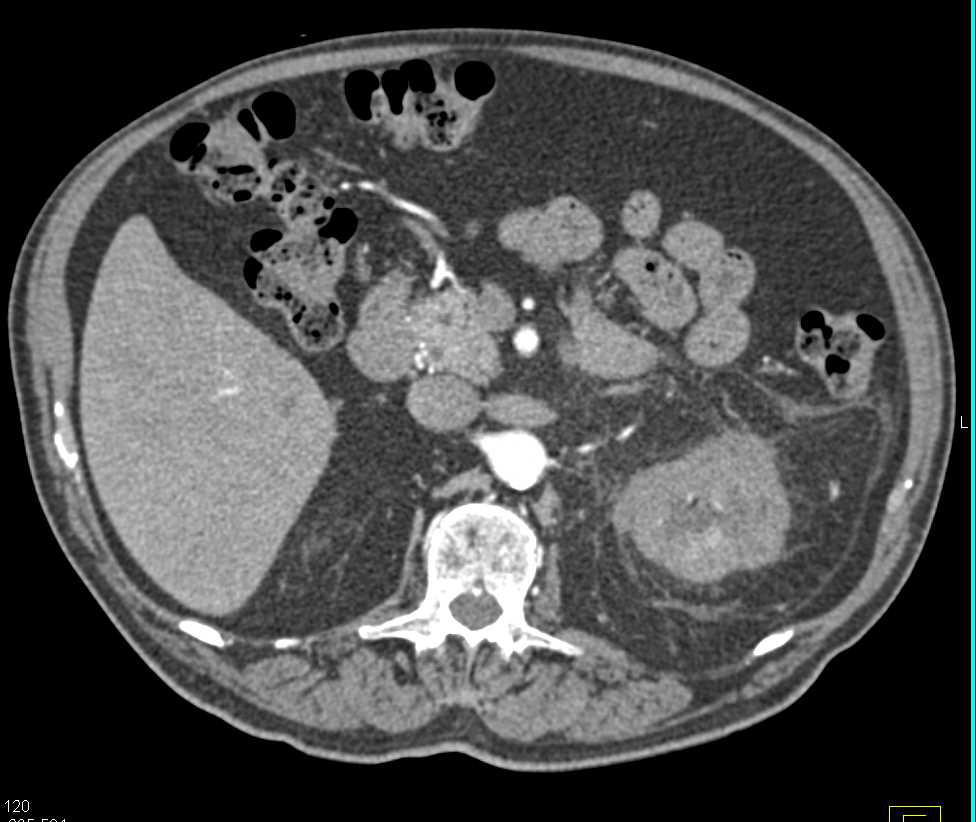 Acute Pyelonephritis - CTisus CT Scan