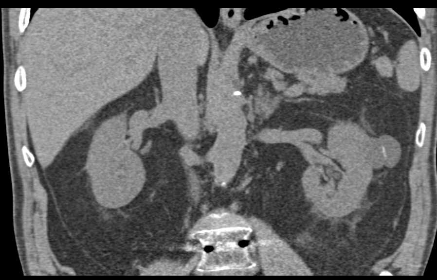 Bosniak 2F Cyst Left Kidney - CTisus CT Scan