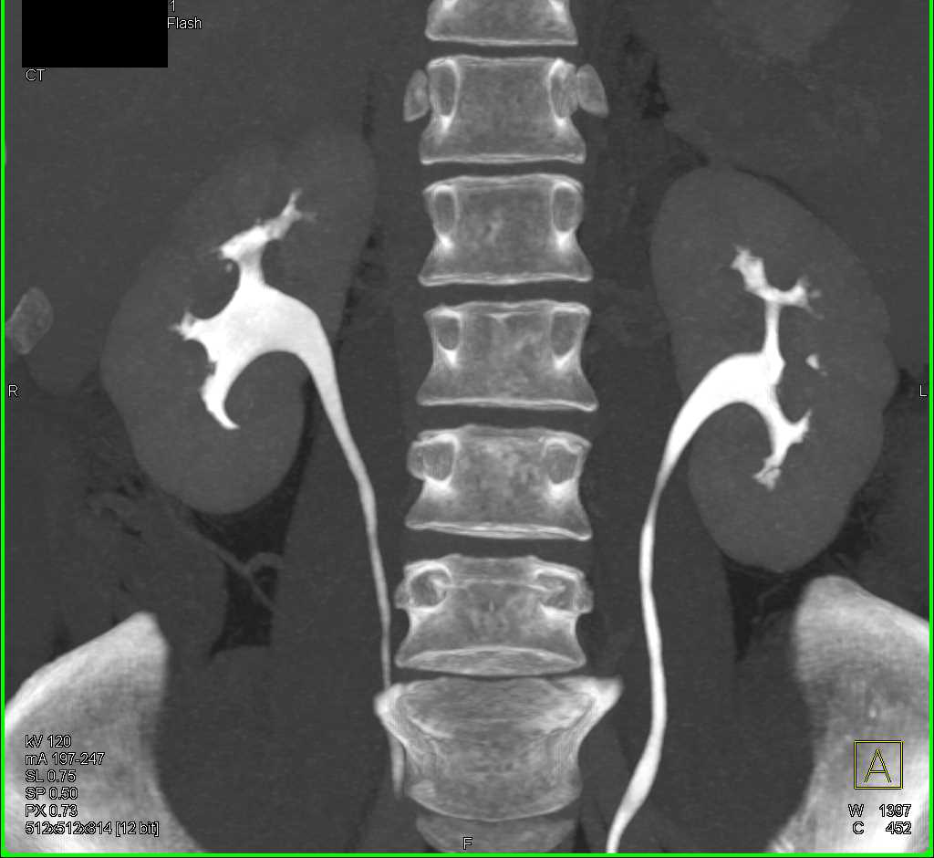 Subtle Papilitis on CT Urogram - CTisus CT Scan