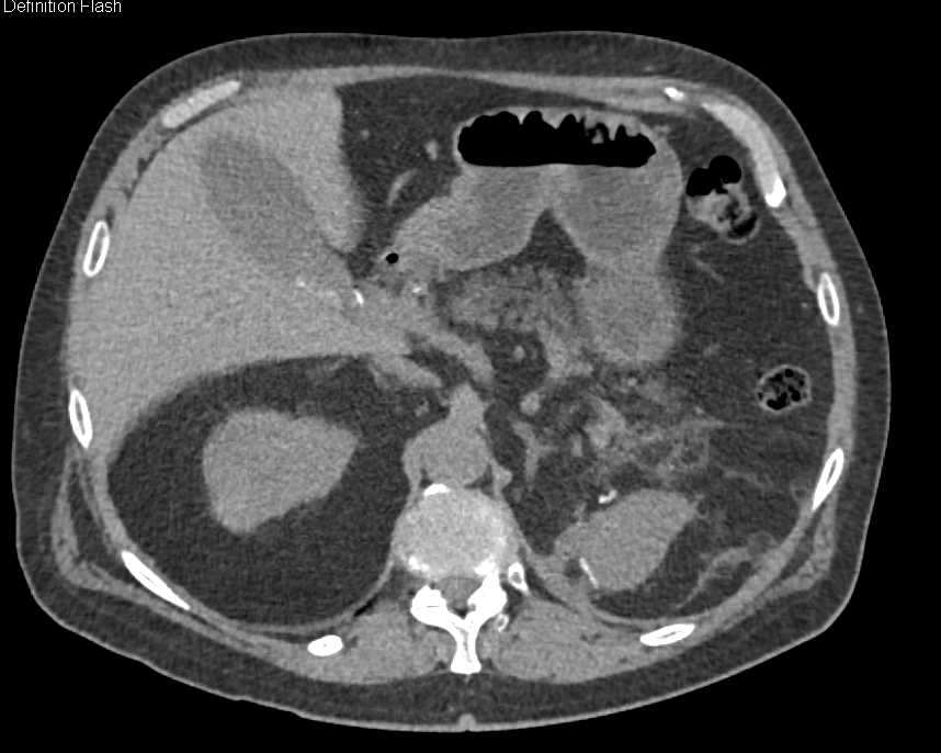 Renal Cell Carcinoma with Arteriovenous (AV) Shunting in the Tumor - CTisus CT Scan
