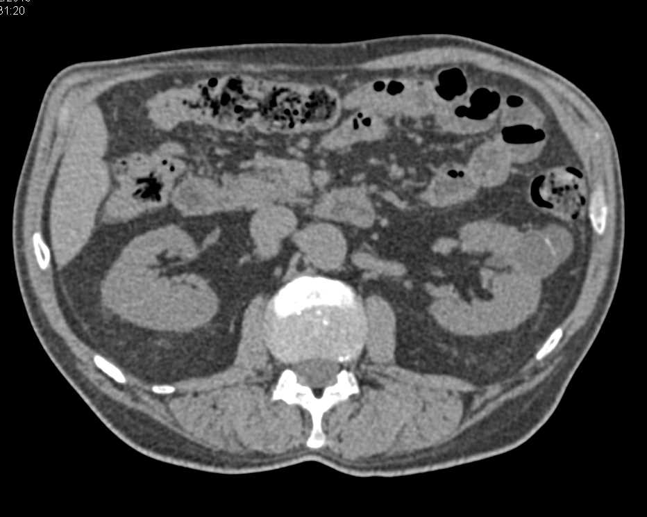 Bosniak 2 Cyst Left Kidney - CTisus CT Scan