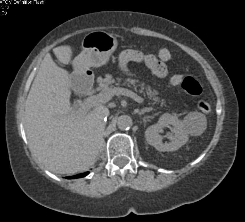 Recurrent Renal Cell Carcinoma Near Nephrectomy Bed - CTisus CT Scan