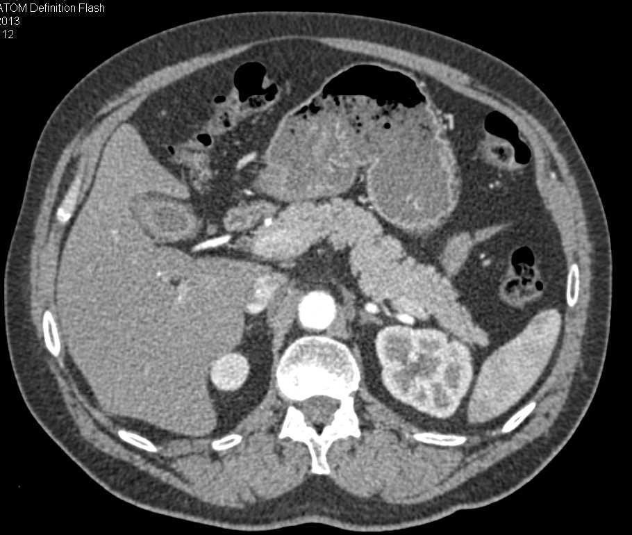 Transitional Cell Carcinoma Left Renal Pelvis and Distal Ureter - CTisus CT Scan