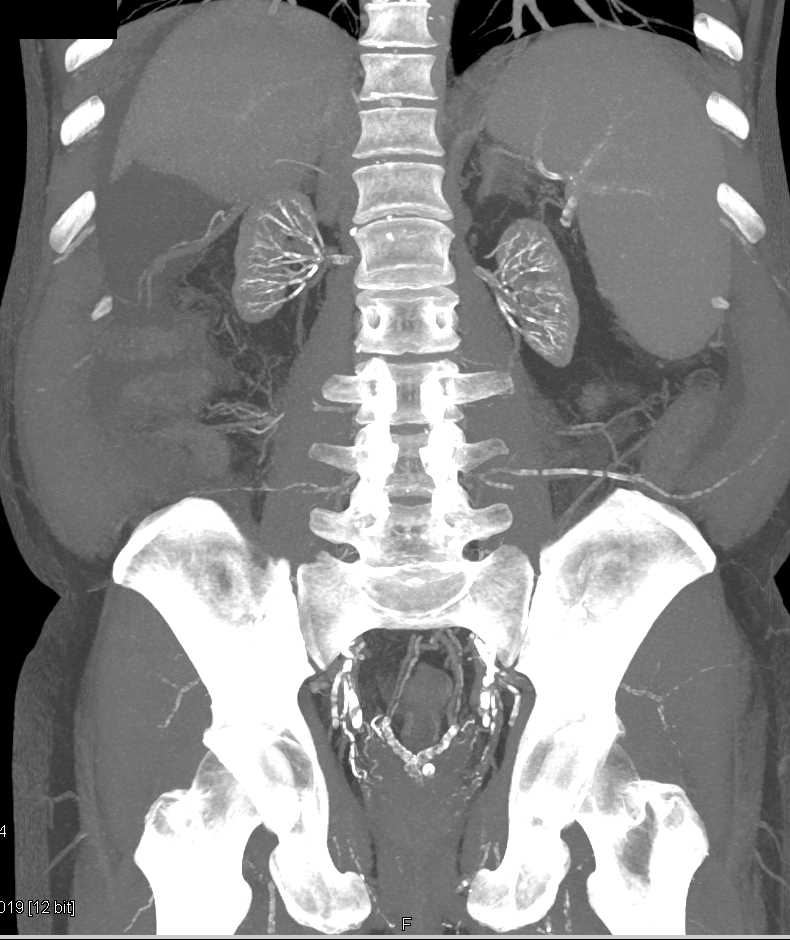 End Stage Renal Disease with Extensive Renal Artery Calcification - CTisus CT Scan