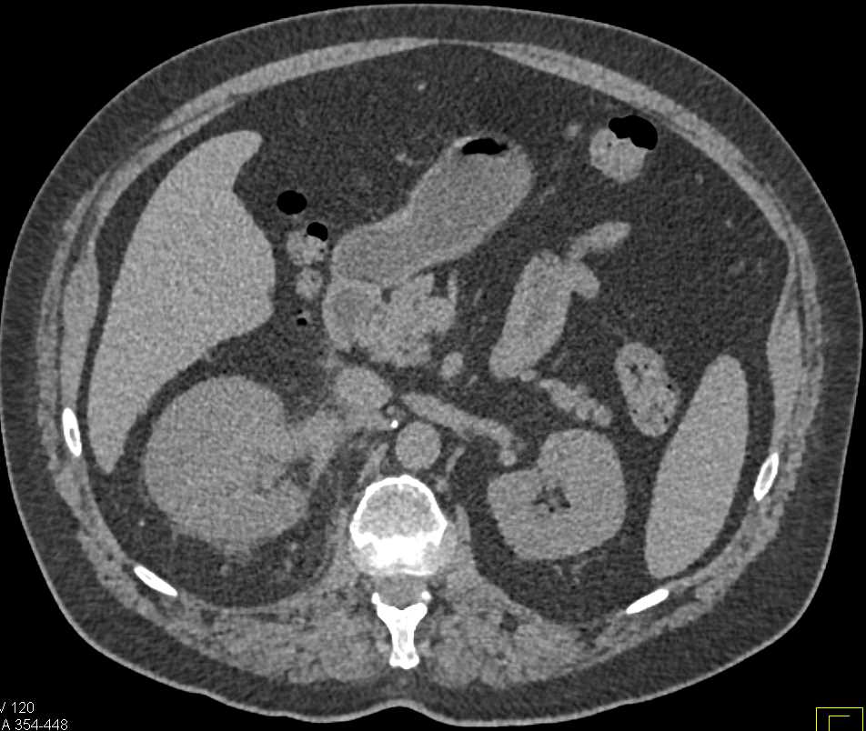Infiltrating Renal Cell Carcinoma Right Kidney with Renal Vein Involvement - CTisus CT Scan