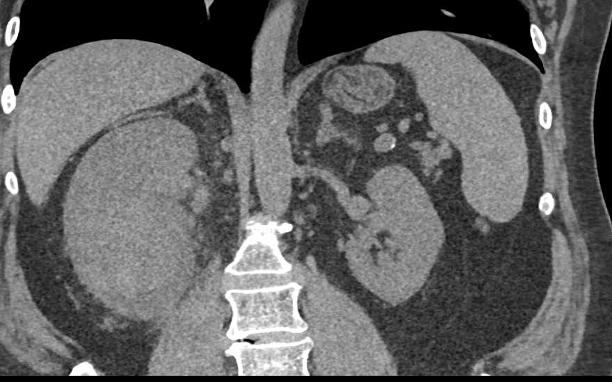 Infiltrating Renal Cell Carcinoma Right Kidney with Renal Vein Involvement and Incidental Right Pulmonary Embolism - CTisus CT Scan