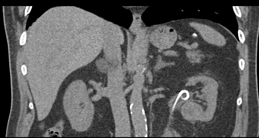 Transitional Cell Carcinoma of the Left Kidney and Ureter - CTisus CT Scan