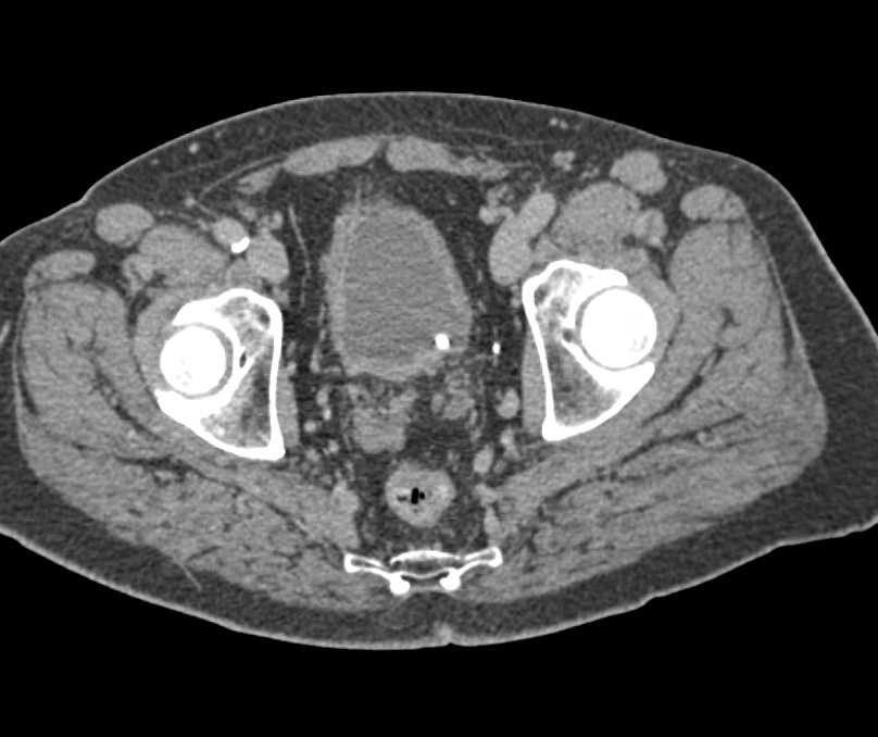 Transitional Cell Carcinoma of the Left Kidney and Ureter - CTisus CT Scan