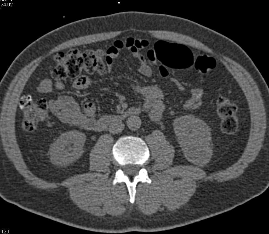 Cystic Left Renal Cell Carcinoma - CTisus CT Scan