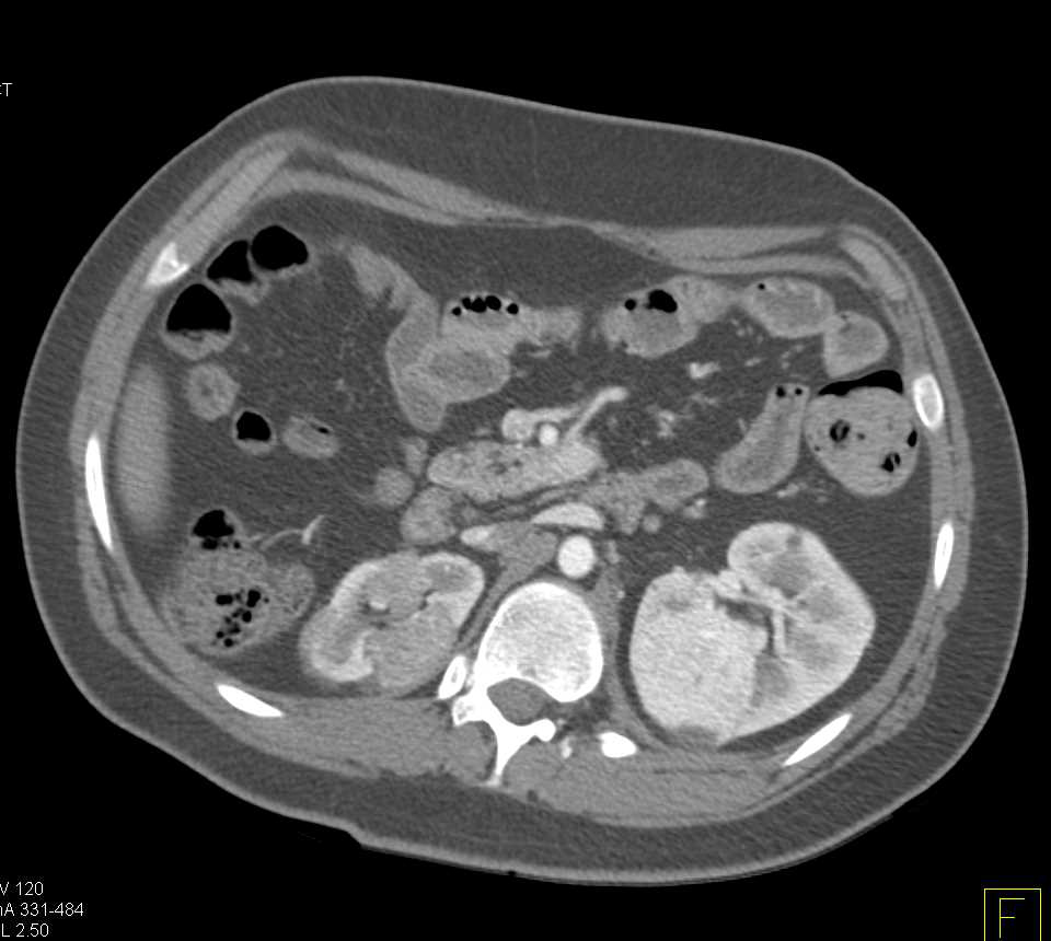 Multifocal renal cell Carcinoma Metastatic to the Pancreas - CTisus CT Scan