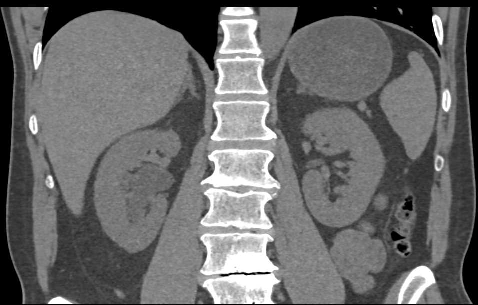 Right Hydronephrosis due to a Stone in the Distal Right Ureter - CTisus CT Scan