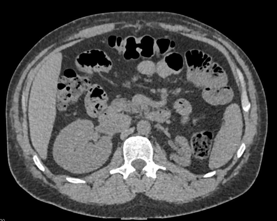 Atrophic Left Kidney - CTisus CT Scan