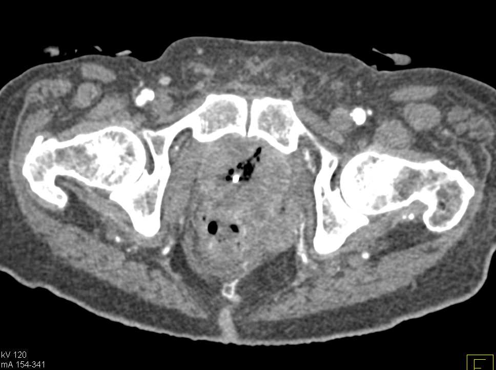 Necrotic Bladder Cancer in Pelvis with Filling Defects Left Renal Pelvis - CTisus CT Scan