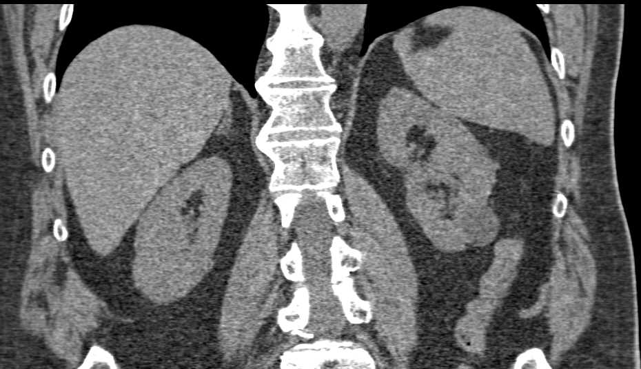 Carcinoma of Proximal Third of Right Ureter - CTisus CT Scan