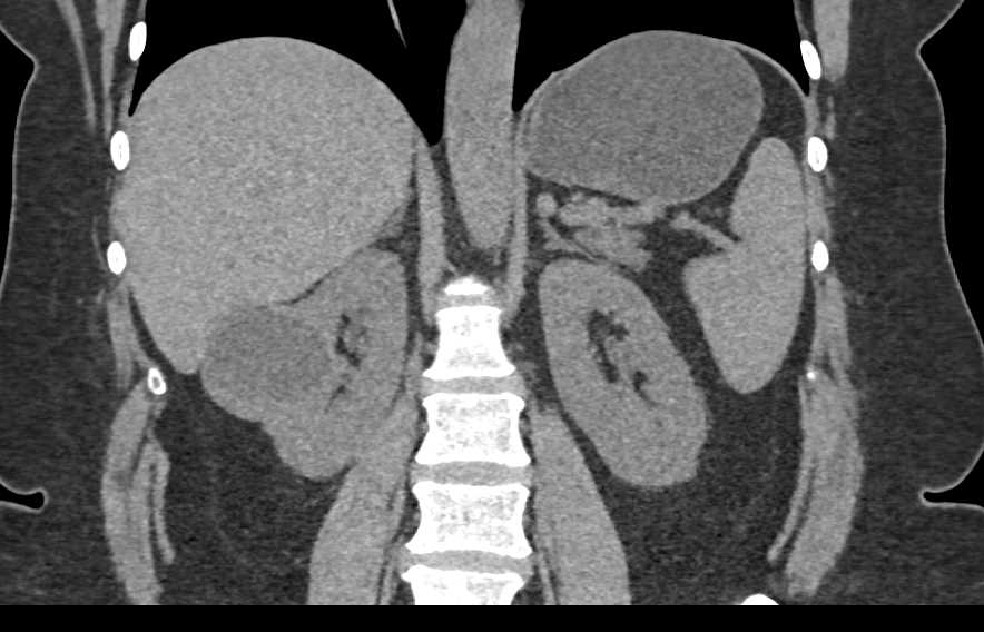 Bosniak 2F Cyst Right Kidney - CTisus CT Scan