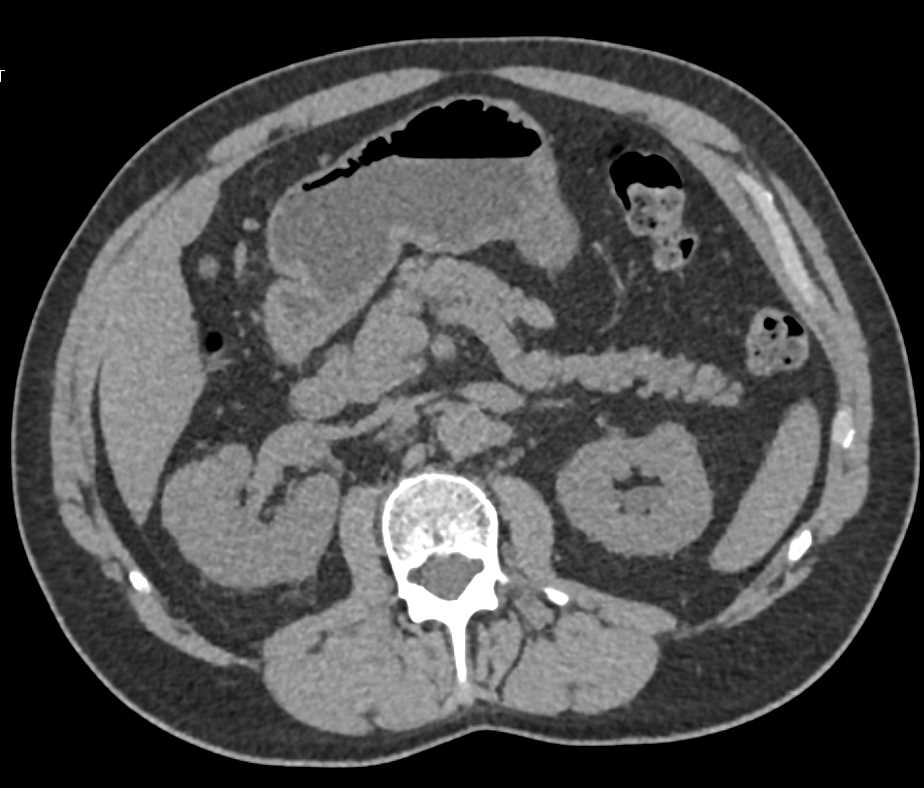 Incidental Clear Cell Renal Cell Carcinoma Right Kidney - CTisus CT Scan