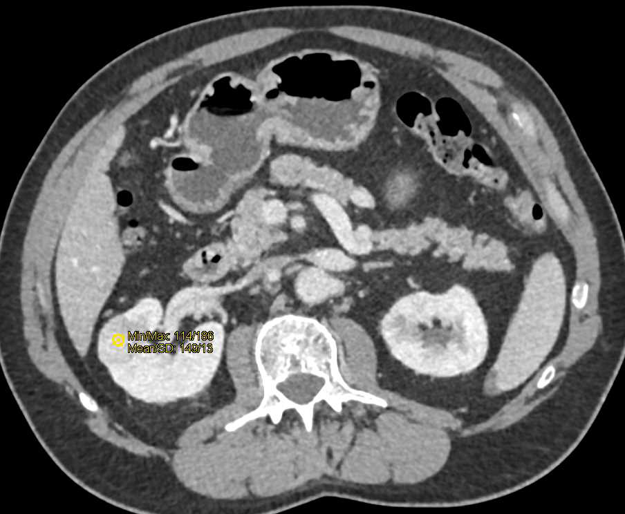 Incidental Clear Cell Renal Cell Carcinoma Right Kidney - CTisus CT Scan