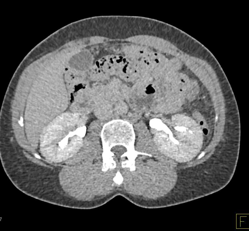 Classic Case of Papillary Necrosis - CTisus CT Scan