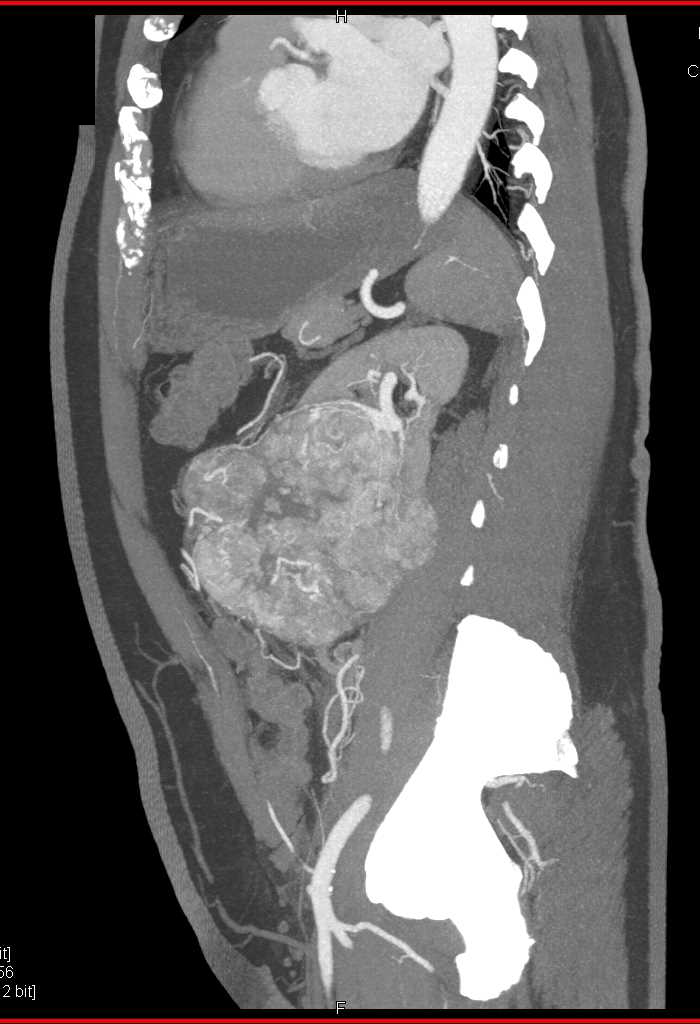 Clear Cell Renal Cell Carcinoma - CTisus CT Scan