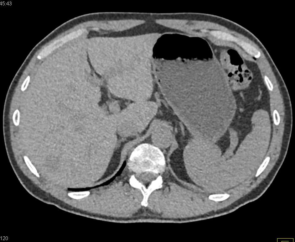 Parapelvic Cysts Left Kidney - CTisus CT Scan