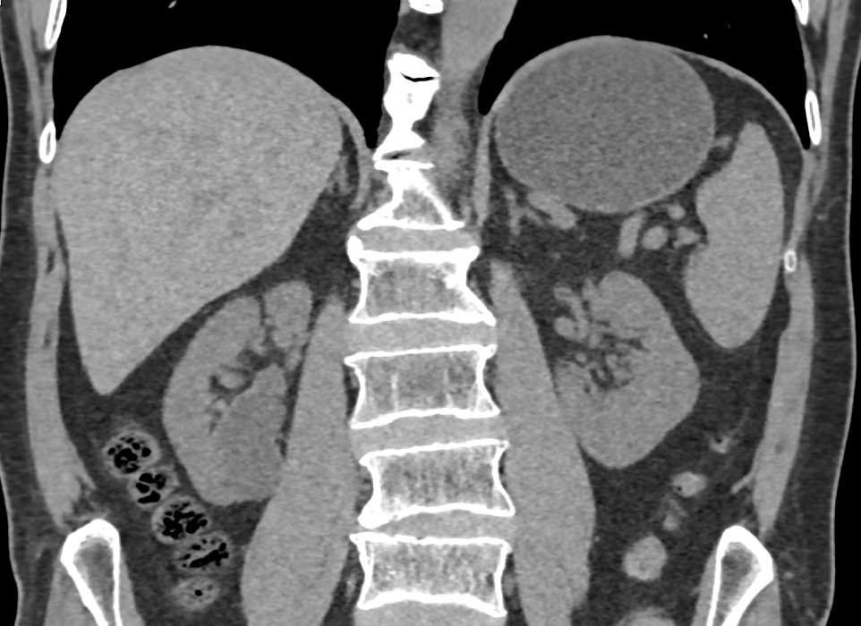Bosniak 1 Cysts Right Kidney - CTisus CT Scan