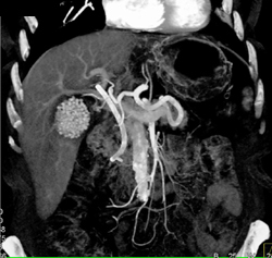 Gall Stones and Pancreatic Cancer With Stent in Place - CTisus CT Scan