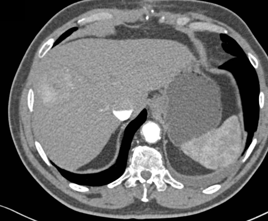 Hepatocellular Carcinoma (Hepatoma) with a Pseudocapsule - CTisus CT Scan