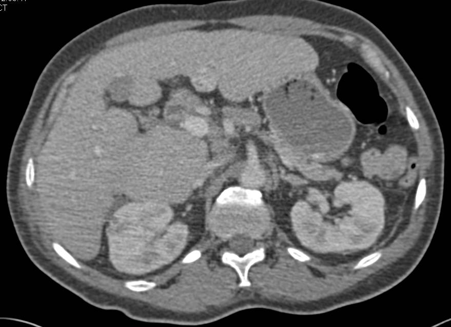 Cirrhosis with Enlarged Caudate Lobe with Small Periportal Nodes - CTisus CT Scan
