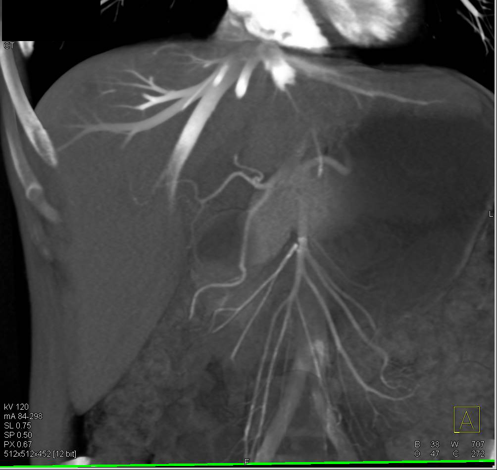 Reflux of Contrast Into Inferior Vena Cava (IVC) and Hepatic Veins Shown Nicely in 3D - CTisus CT Scan