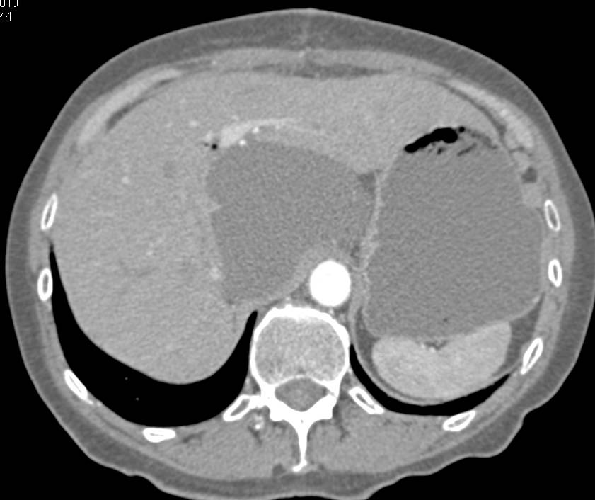 Pseudocyst Pushes Toward the Hilum of the Liver - CTisus CT Scan