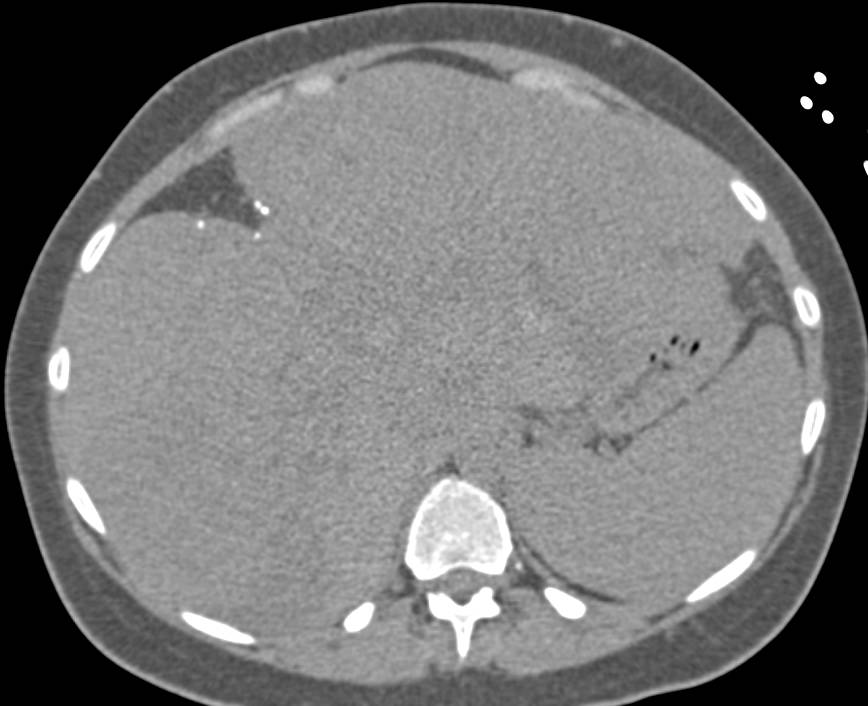 Metastatic Carcinoid Tumor to the Liver with Hypervascular Lesions Shown on All Phases - CTisus CT Scan