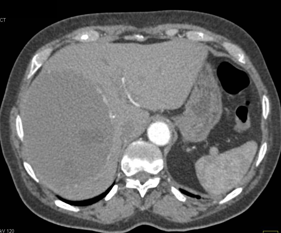 13 cm Giant Cavernous Hemangioma of the Liver - CTisus CT Scan