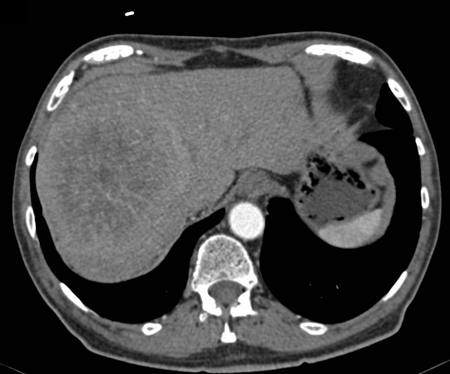 Hepatocellular Carcinoma (Hepatoma) with Pseudocapsule - CTisus CT Scan