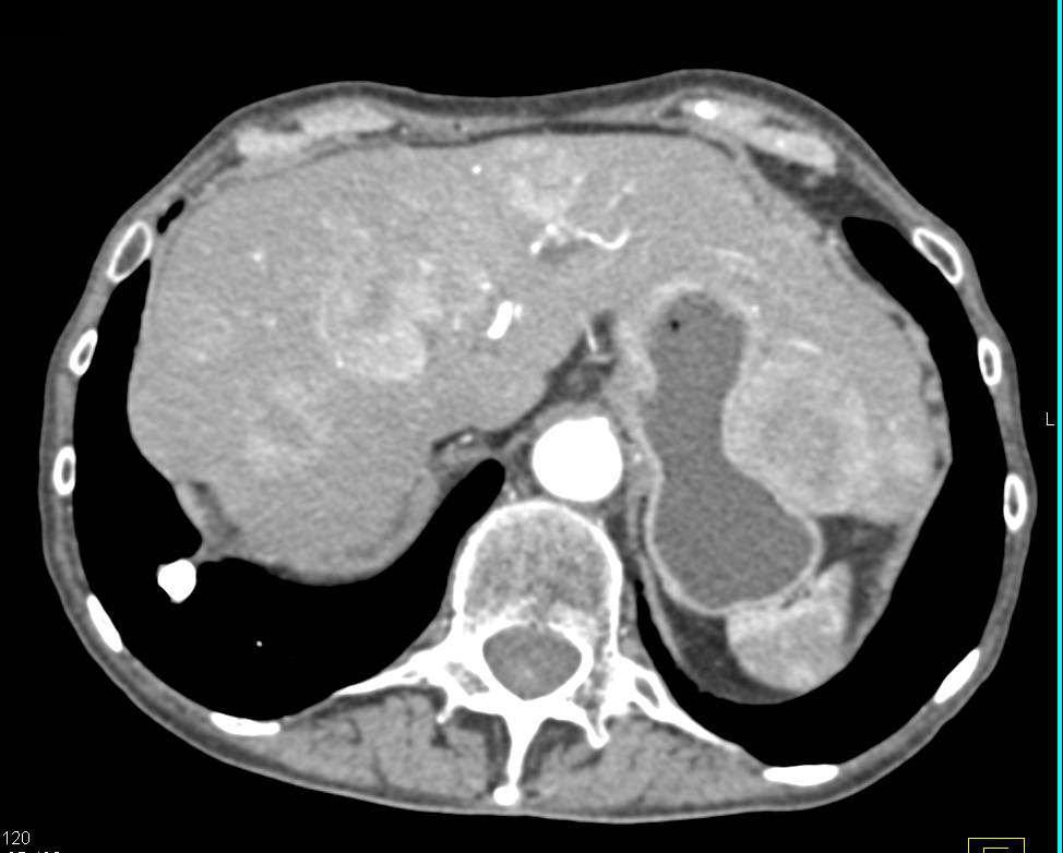 Metastatic Carcinoid Tumor Involves the Liver, Mesentery, Omentum and Small Bowel - CTisus CT Scan