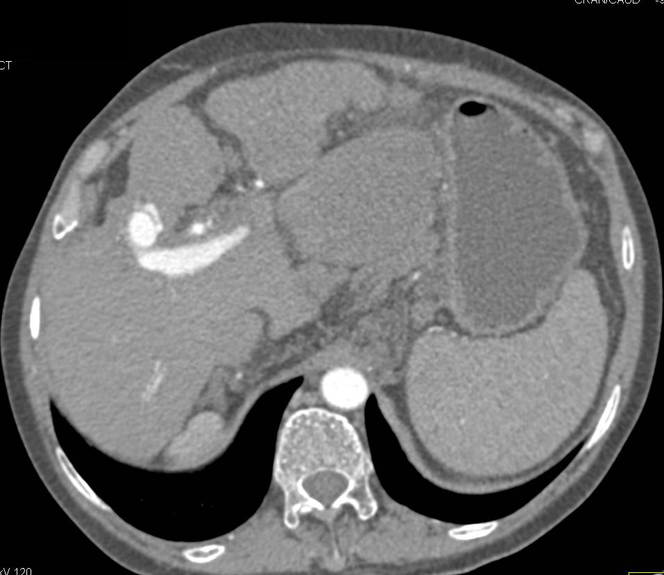 Large Arteriovenous (AV) Fistulae in Cirrhotic Liver with Hepatocellular Carcinoma (Hepatoma) - CTisus CT Scan