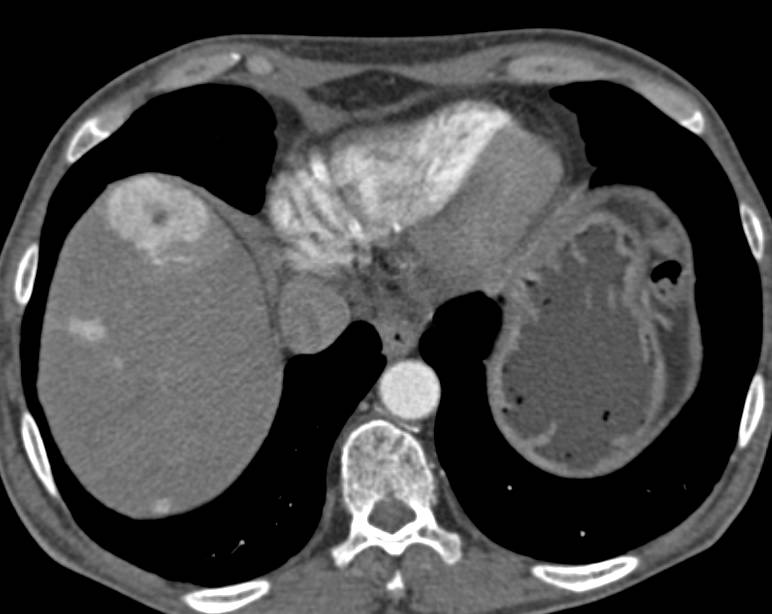 Neuroendocrine Tumor Body of Pancreas with Liver Metastases - CTisus CT Scan