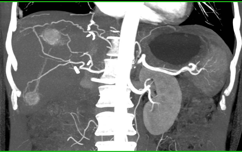 Metastatic Neuroendocrine Tumor to the Liver - CTisus CT Scan