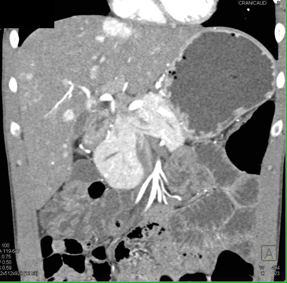 Neuroendocrine Tumor with Vascular Liver Metastases - CTisus CT Scan