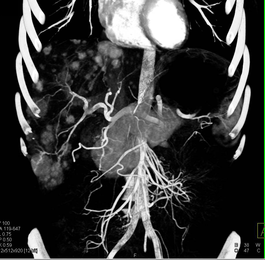Vascular Liver Metastases from Carcinoid Tumor - CTisus CT Scan