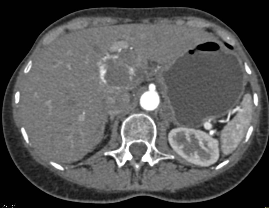 Hepatic Hemangioma and No Evidence of Metastases - CTisus CT Scan