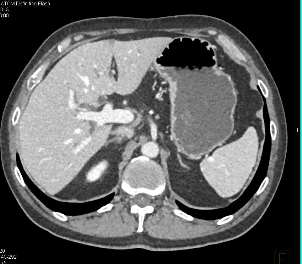 Distal Common Bile Duct Cancer - CTisus CT Scan