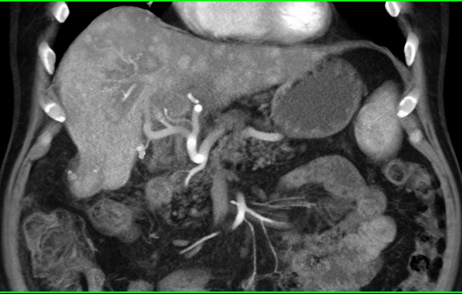 Adrenal Metastases from Hepatocellular Carcinoma (Hepatoma) - CTisus CT Scan