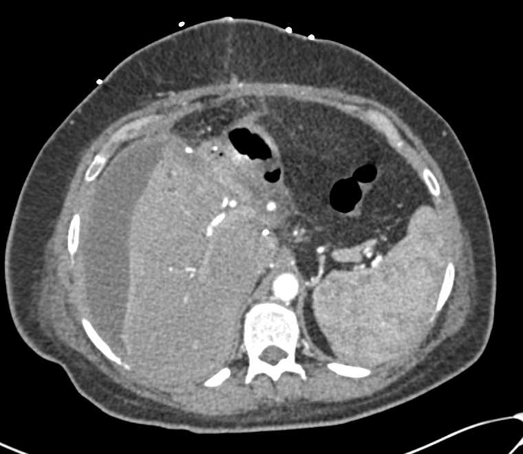 Perihepatic Biloma s/p Liver Surgery - CTisus CT Scan