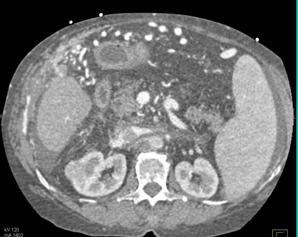 Cirrhosis with Portal Hypertension and Varices - CTisus CT Scan
